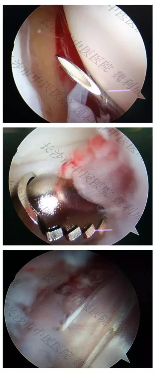 手腕囊肿抽吸出来后可否继续按压,足背囊肿穿刺好还是切除好