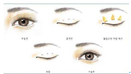 常见的几种双眼皮,常见双眼皮的手术方法及利弊