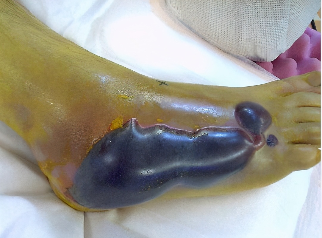 骨折水泡结痂多久脱落,手腕骨折出现水泡