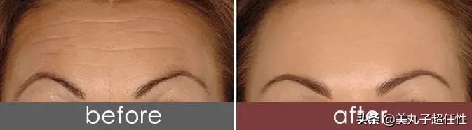 原来解决抬头纹这么简单,一个方法轻松解决抬头纹