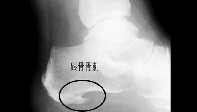 早起下床脚跟痛,早起下床脚踩地脚掌刺痛