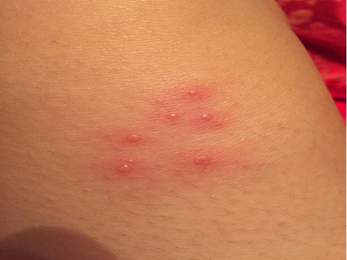 被隐翅虫咬伤有多可怕,被隐翅虫咬后症状图片及治疗方法