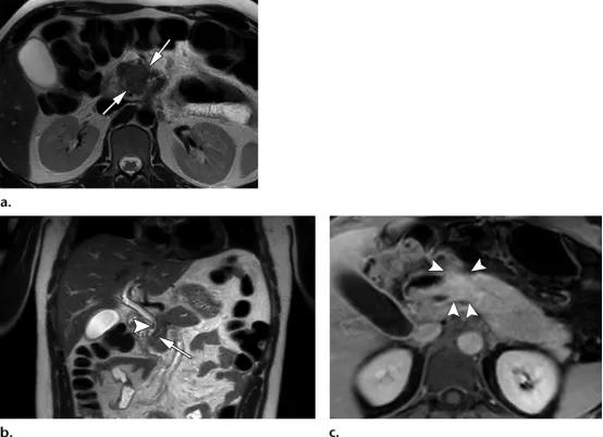 急性胰腺炎和慢性胰腺有什么症状,胰腺炎合并胰腺肿物
