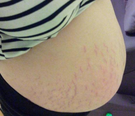 有多少人在怀孕期间出现妊娠纹,怀孕怎么样才不容易有妊娠纹