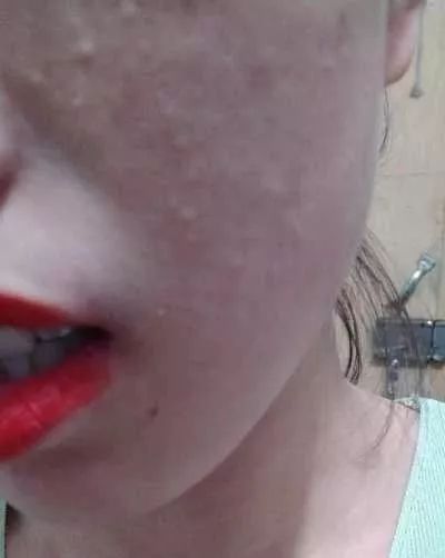 辟谣逆光疹,逆光疹是伪概念吗