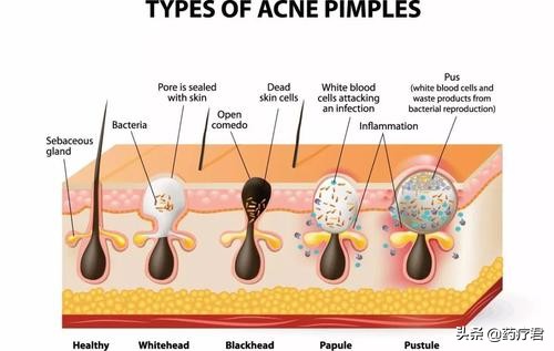 脸上有痘印痘坑怎样可以去掉,脸上痘印痘坑用什么可以去掉