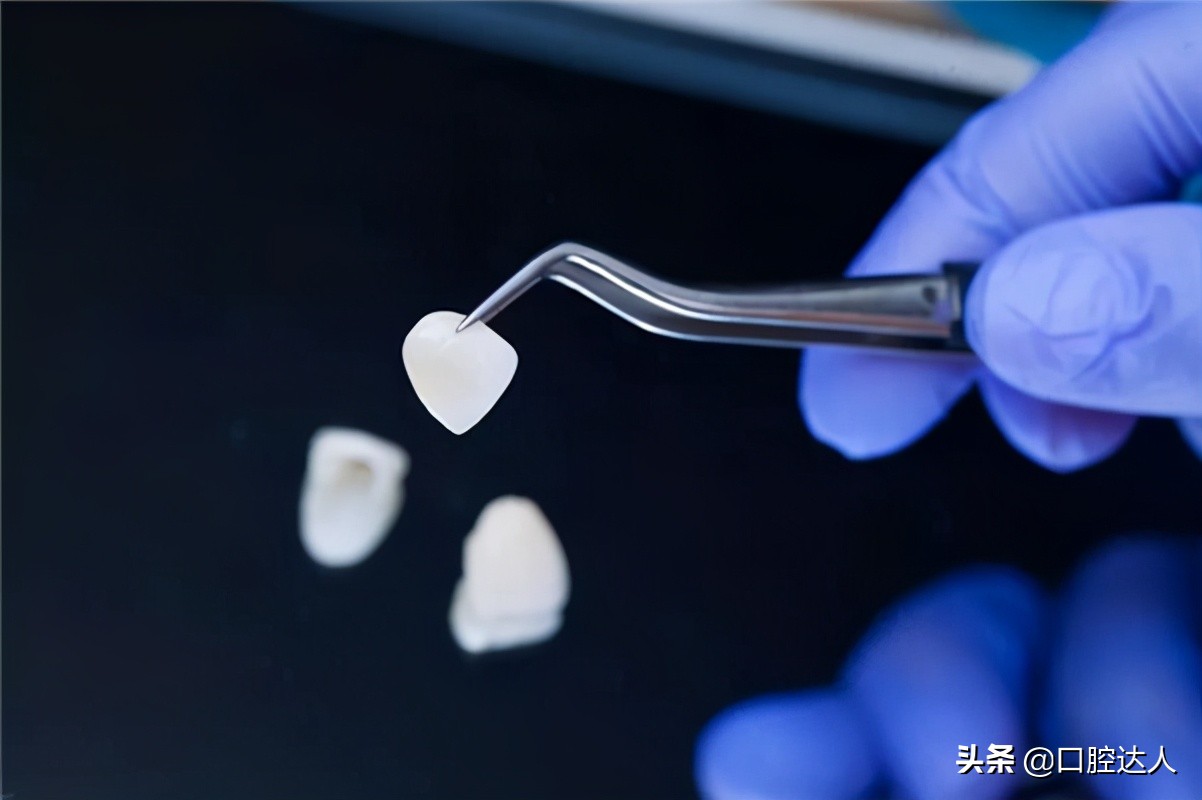 有牙缝做牙齿贴面好还是矫正好,牙缝太大先矫正再做贴面