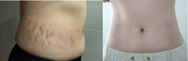 有妊娠纹不要怕一招教您轻松淡化,妊娠纹防不胜防你知道如何修复吗