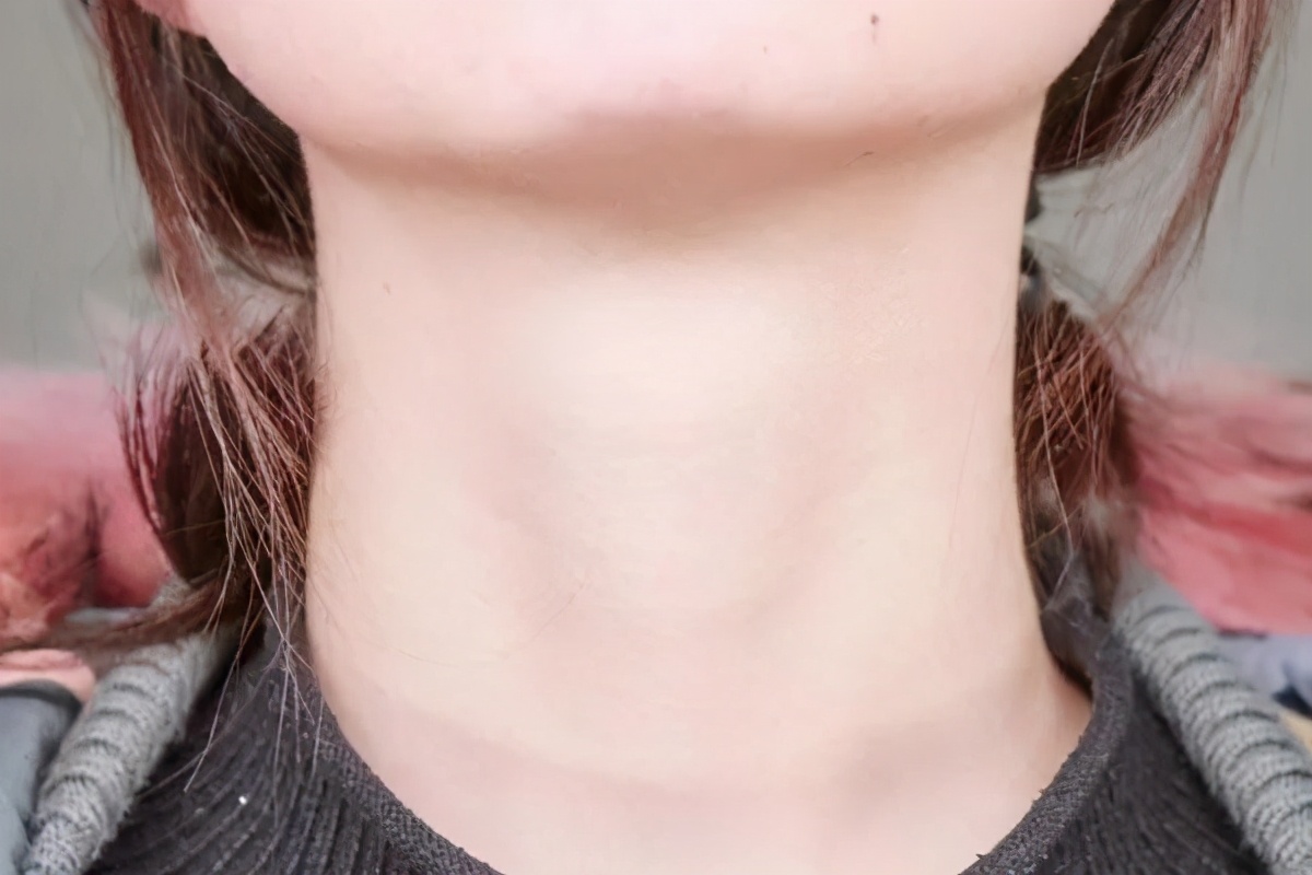 脖子上长了一个超级小的肉疙瘩,脖子里面长了一个疙瘩肉眼可见