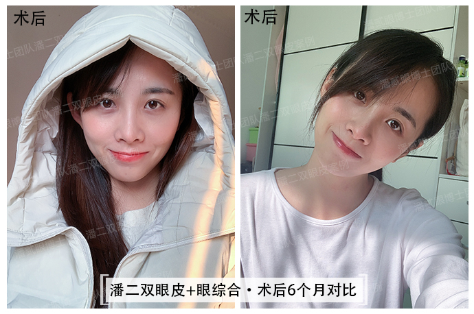 眼综合可以去掉抬头纹吗,眼综合抬头纹