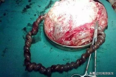 免疫不良妊娠是什么意思,免疫导致不良妊娠怎么干预