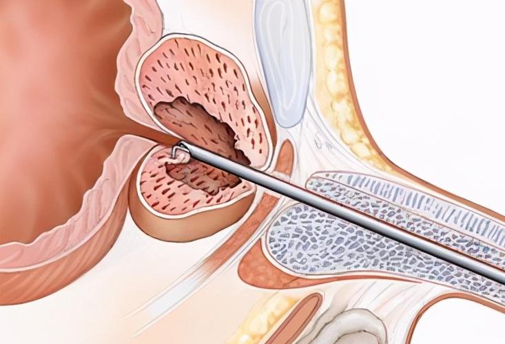23岁前列腺肥大是什么原因引起,前列腺增生肥大吃什么缓解症状
