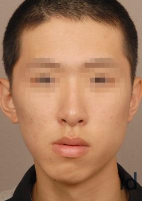 打溶脂针和瘦脸针哪个副作用大,打瘦脸针有没有副作用和后遗症