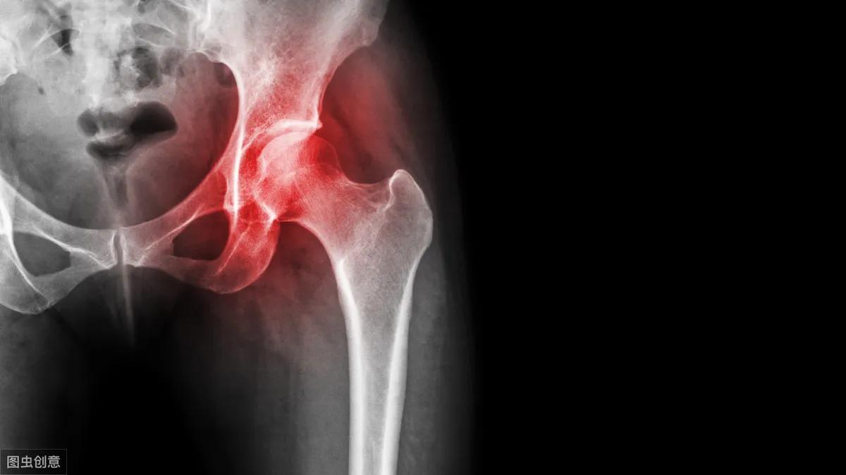 老人摔倒股骨颈骨折最佳治疗方案,老年人常见骨折部位是髋部骨折吗