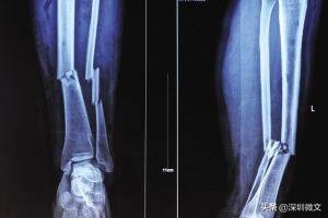 核磁共振原理和ct有什么区别,x光核磁ct的区别图片