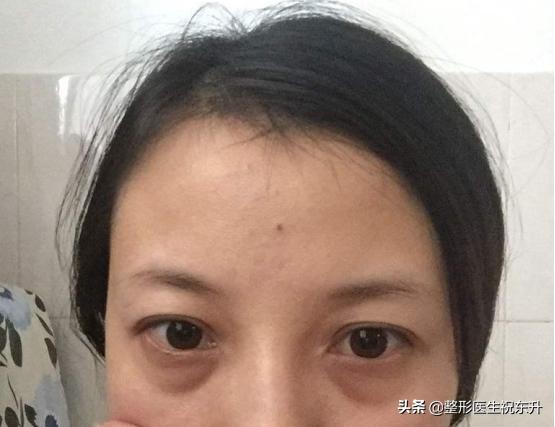 眼袋大用什么化妆品能修复,眼袋大怎么办用什么护肤品好