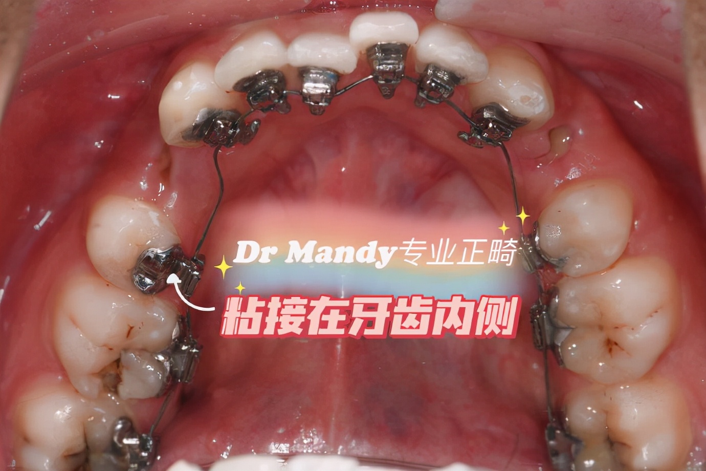 杭州如何选择牙齿矫正,杭州牙齿矫正哪个医生好