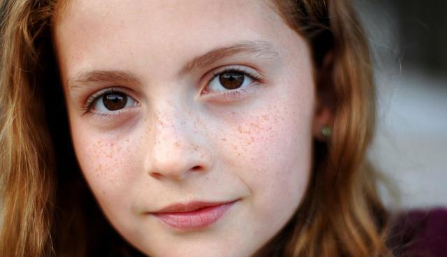 脸上雀斑祛斑最好最安全的方案,根治雀斑祛斑最有效方法