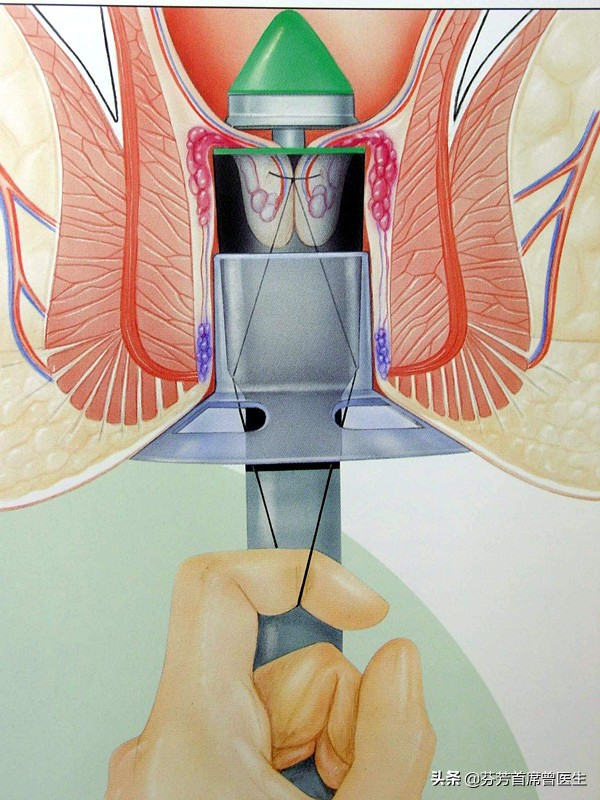 痔疮传统手术和pph手术的区别,痔疮手术是个小手术还是大手术