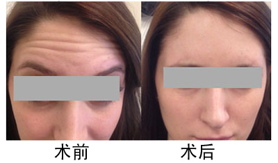 亳州利辛县热玛吉除皱术,亳州热玛吉除皱术