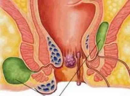 中医治疗肛痈的方剂组成,肛痈偏方