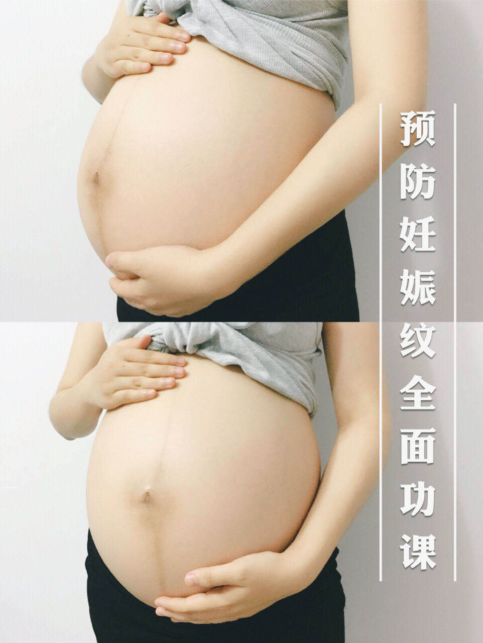 最好用的防妊娠纹产品,妊娠纹修复霜可以预防孕纹吗