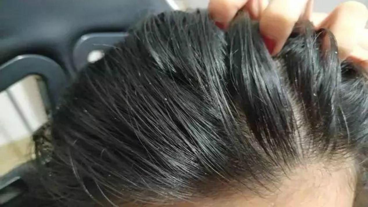 头皮屑反反复复的怎么治疗,头皮屑反反复复是什么原因导致的