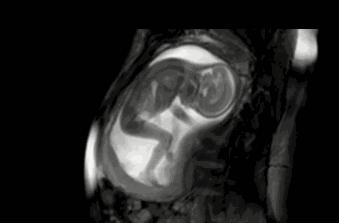 胎儿在妈妈肚子里干什么图片,胎儿在妈妈肚子里的位置变化