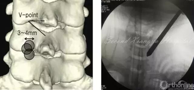 经皮腰椎间盘切除术有何优缺点,什么是经皮内镜腰椎手术