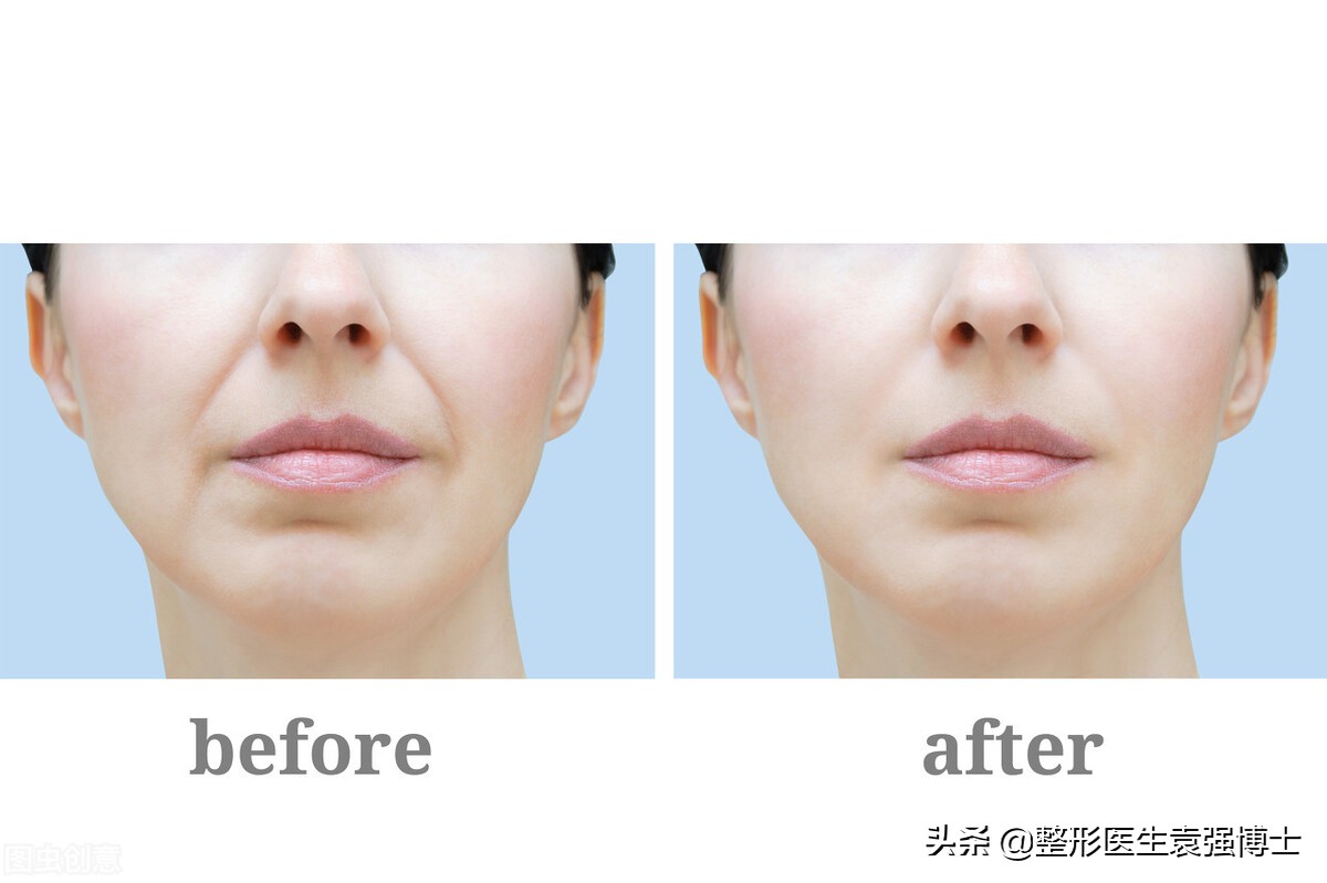 整形医生说医美后遗症,整容拉皮能拉法令纹吗