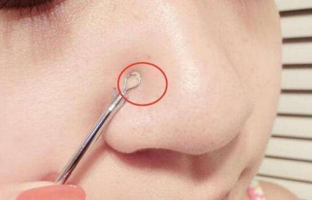 「丽皙白美肤」收下这份黑头作战攻略，让你摆脱尴尬草莓鼻！