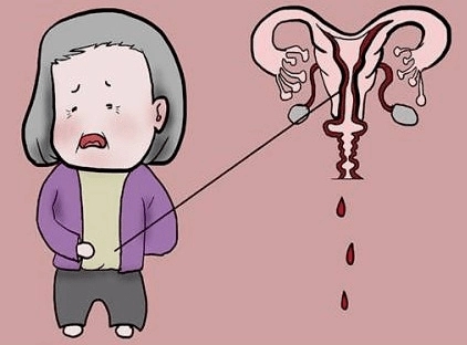 更年期女性一直出血怎么办,女人更年期会有出血的现象吗