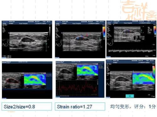 乳房体检有结节普遍吗,乳房结节自我诊断