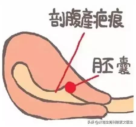 切口妊娠的孩子能要吗,怀孕多久可以查出切口妊娠