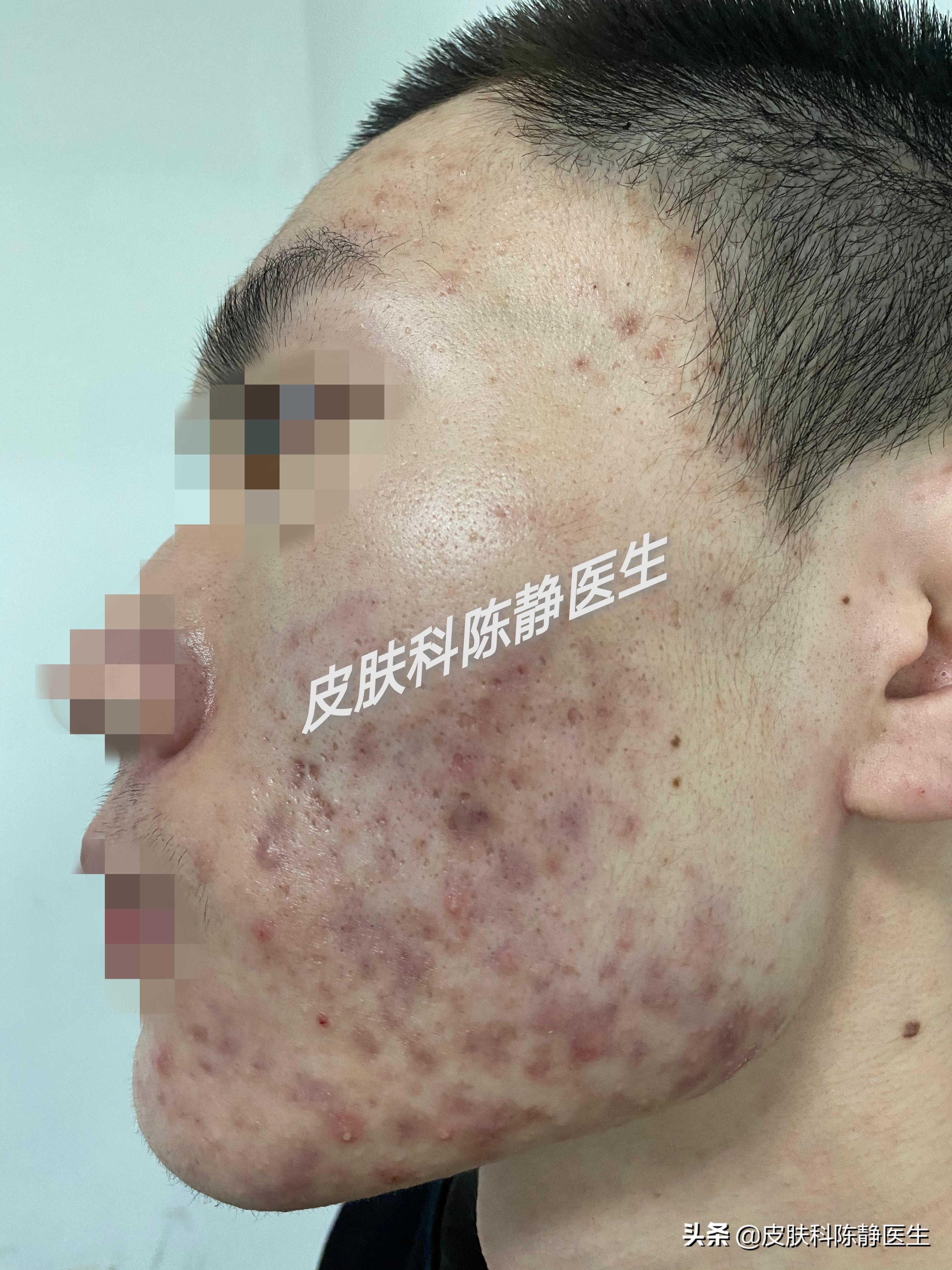 皮肤科刷酸要多长时间,医院皮肤科刷酸一次多少钱