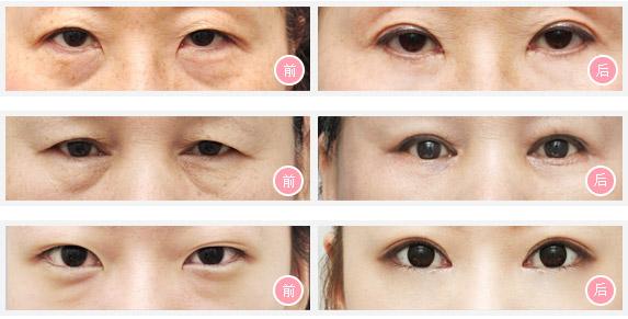 眼袋过大是什么原因怎么办,请问眼袋大是什么引起的怎么治疗