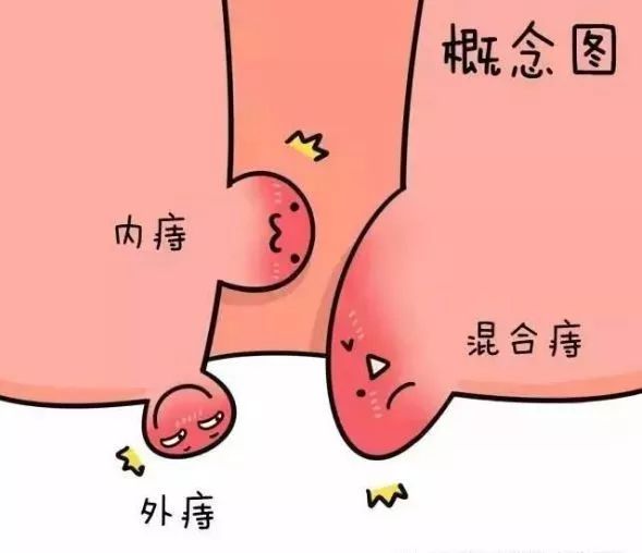 肛肠几个月痛一次,内痔肛肠镜痛吗