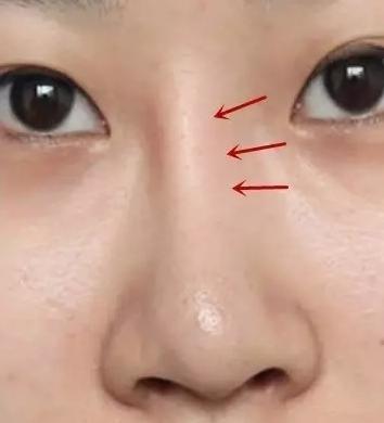 余文林鼻子修复方法,余文林修复嘴唇怎么样