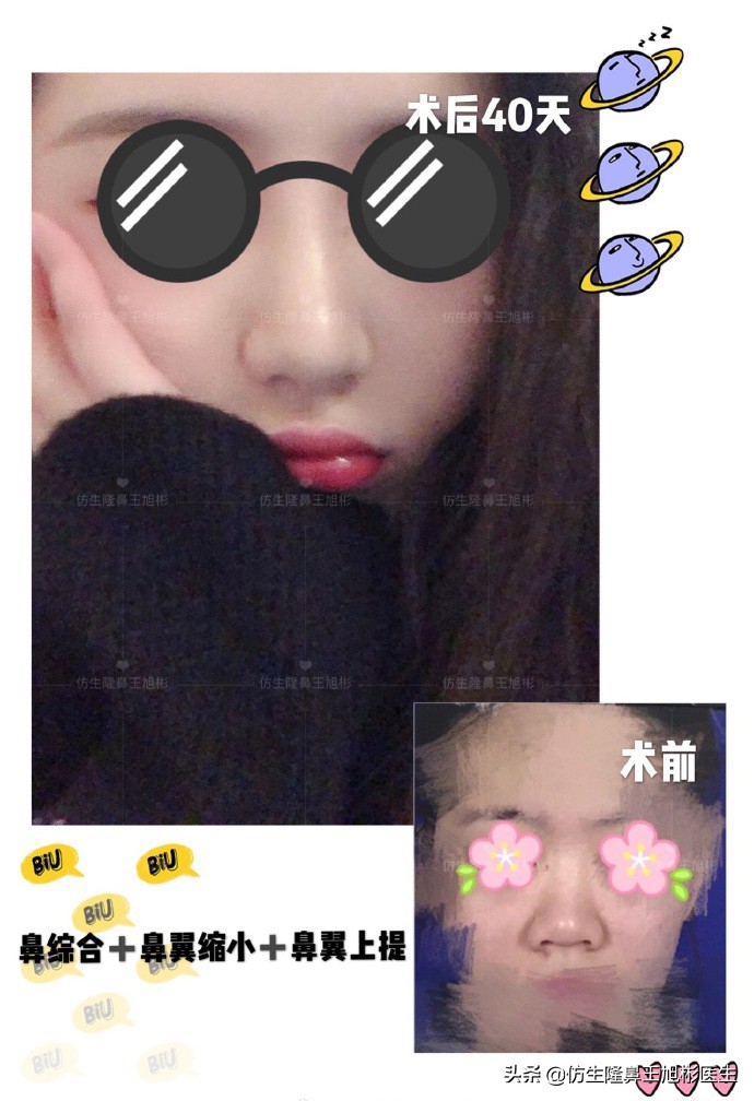 隆鼻鼻头大是失败了吗,大鼻头隆鼻手术案例