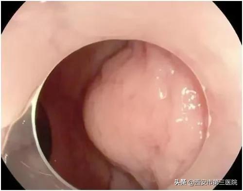 微创时代|内镜下微创直肠肿瘤切除，为您保“肛”