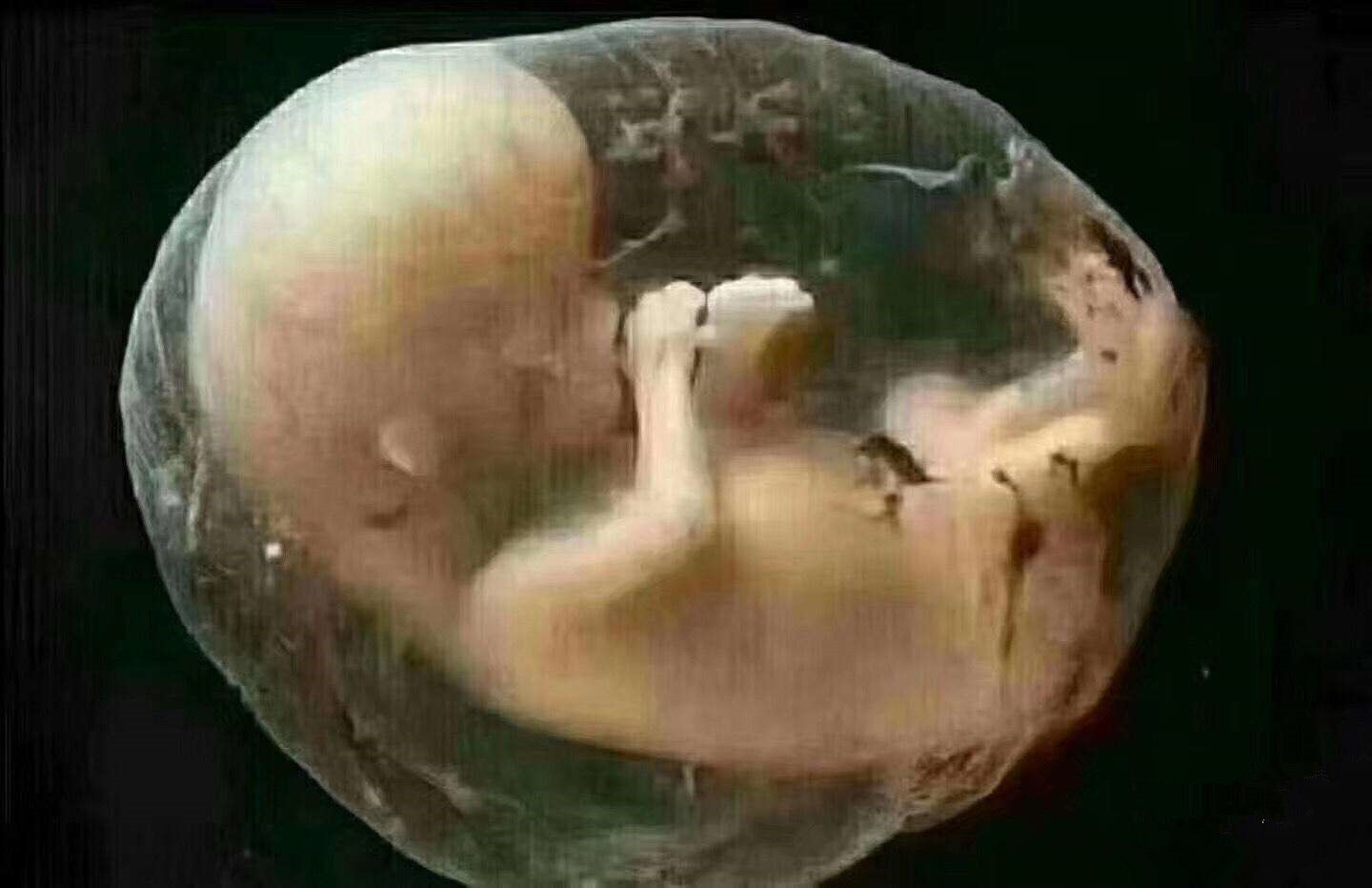 孕妈怀巨大儿想顺产,孕妈生出肉球