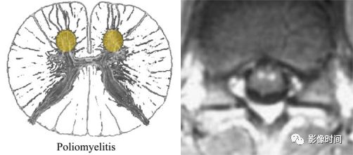 脊髓病变案例图文问诊,脊髓病变视频