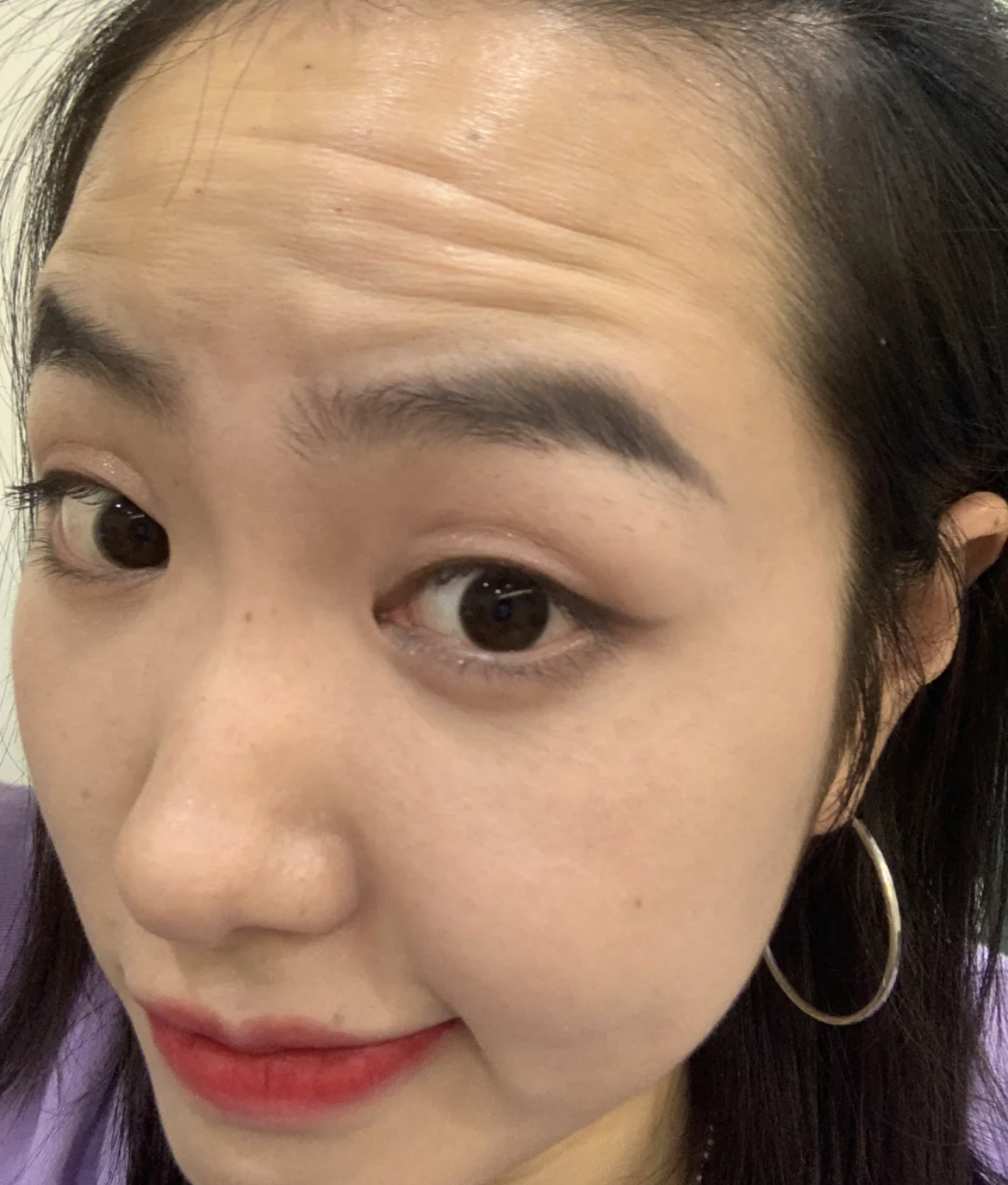 眼尾有皱纹怎么治疗,眼尾沟里面有皱纹怎么办