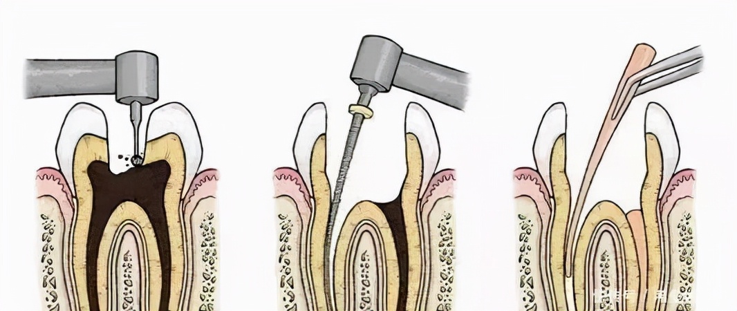 板牙劈裂是种植牙好还是戴牙套好,牙齿要烂成什么样子才要种植牙齿