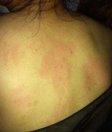 后背长痘痘的原因和解决方法图文,后背长痘痘如何正确有效解决