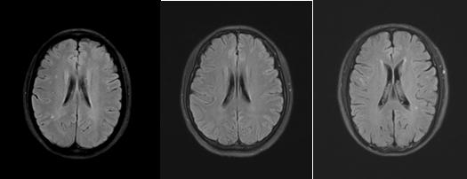 颅脑mr异常啥意思,颅脑mri未见明显异常说明什么