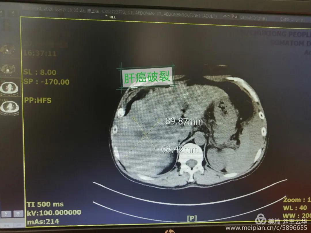 楚雄州人民医院肝胆外二科,四川省人民医院肝胆外科治疗肝癌