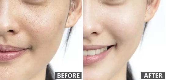 除皱效果最好的方法,全球公认效果最好的除皱方法