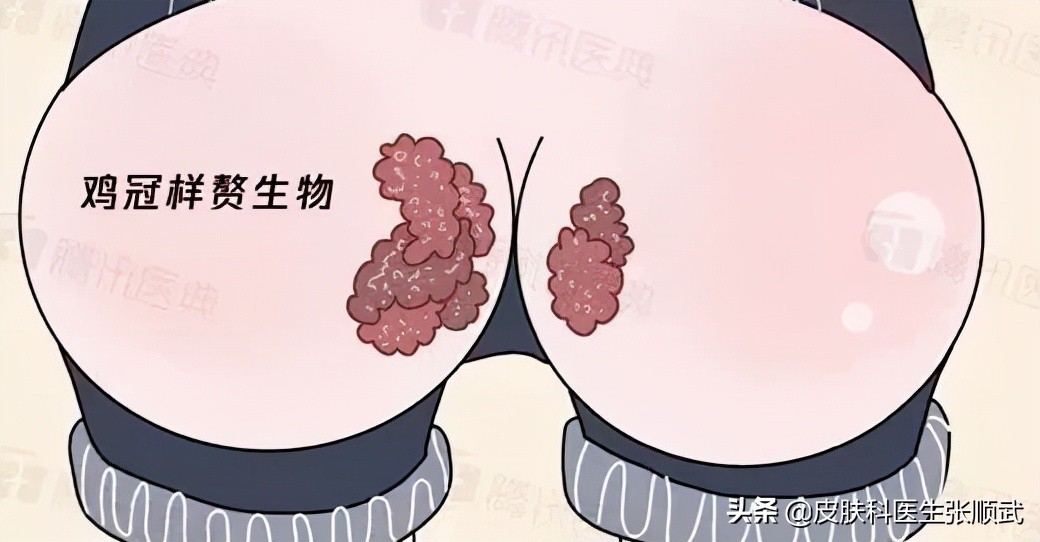 尖锐性湿疣长得像痘痘吗,尖锐性湿疣长得和痘痘一样大