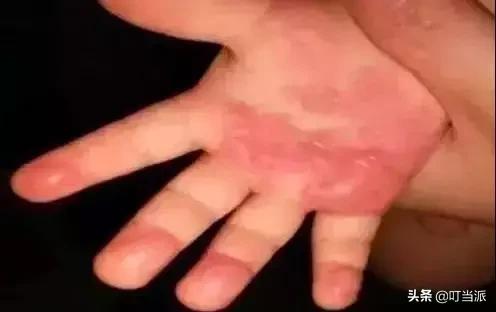 小孩玩健身器材死亡后续,小男孩玩健身器材时夹骨折